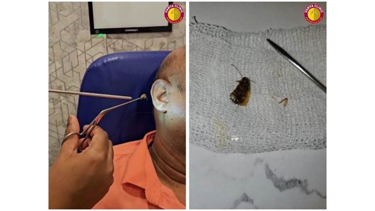 Cockroach in Ear: Dr. Purodha Prasad Saves Delhi Patient in Emergency ENT Case-PNN